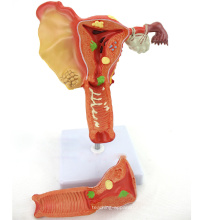 ANATOMIA35 (12473) Ciência Médica Humana Modelo Patológico Uterino Feminino